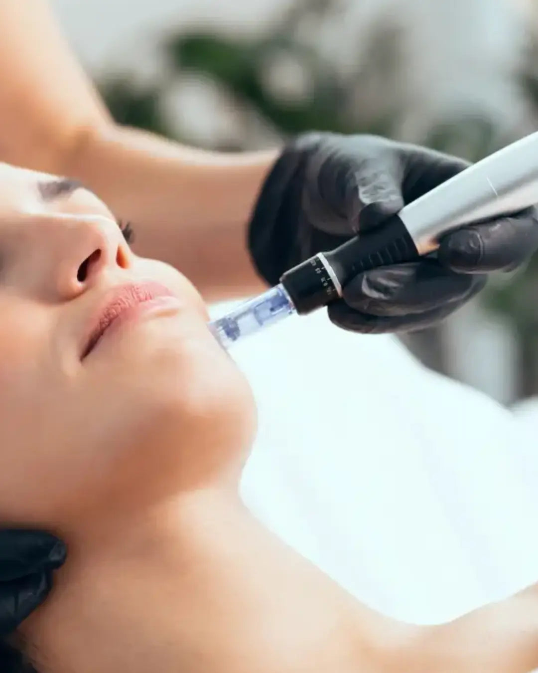 Microneedling (Face and Body)
