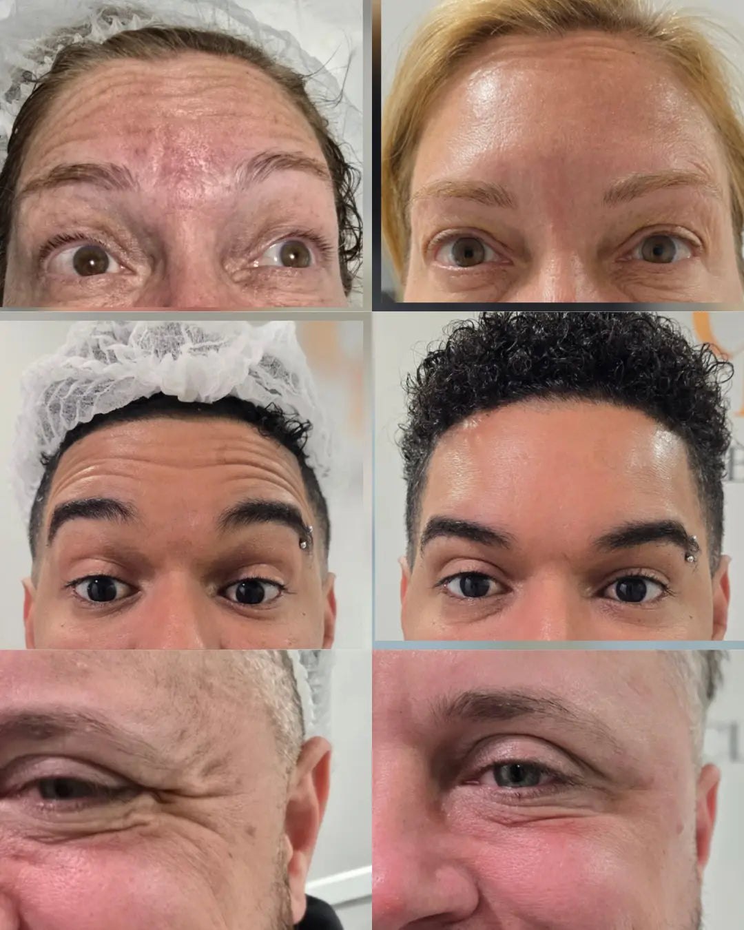 Botox Treatment