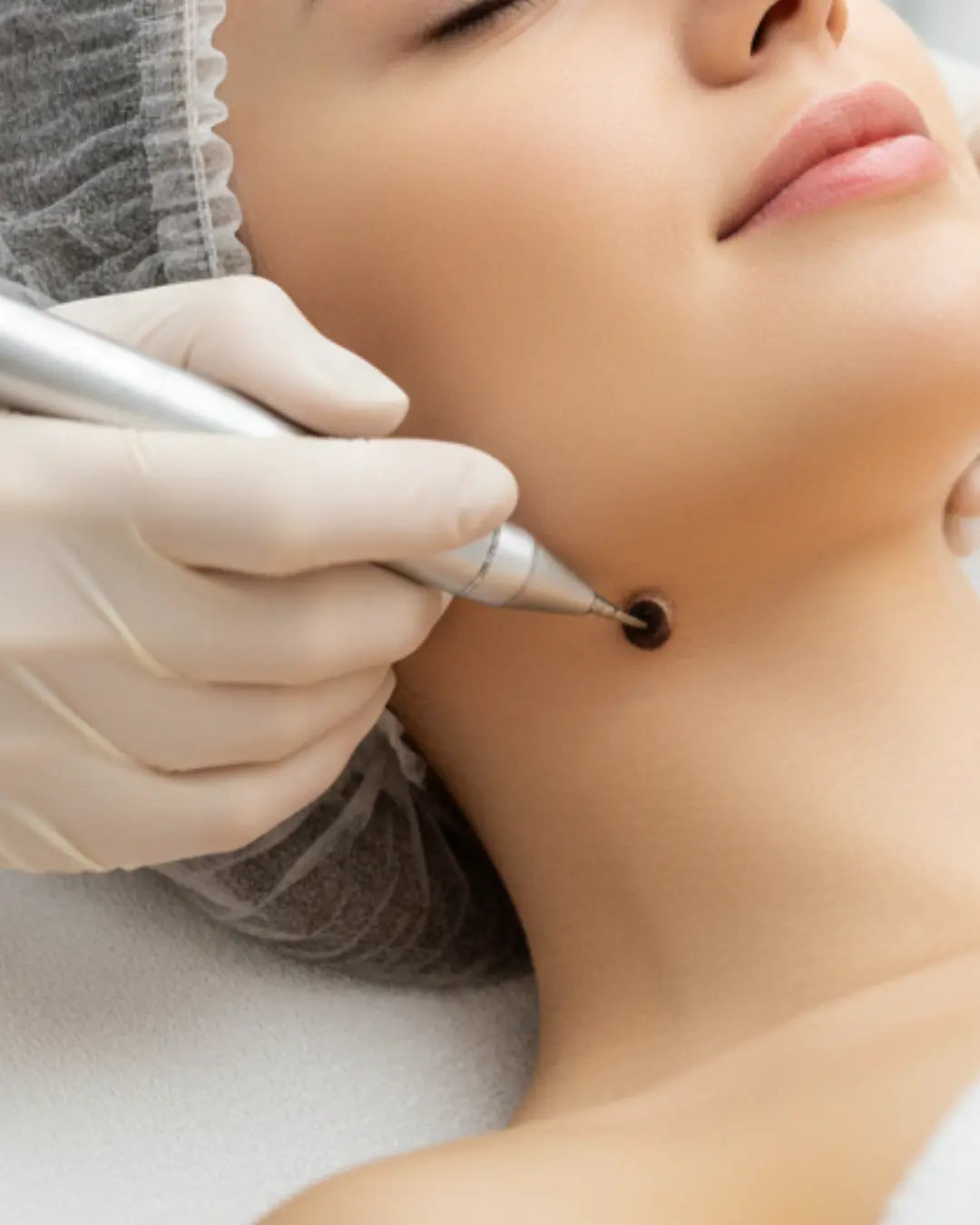 Skin Tags Removal